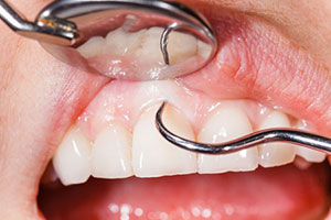 Dental Implants Pikesville
