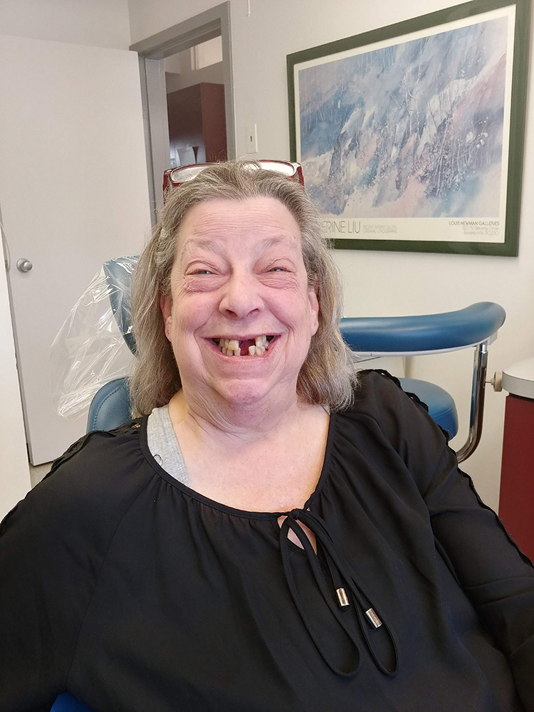 Implant Supported Dentures in Baltimore